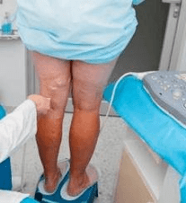 ¿Qué son las venas varicosas