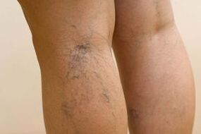 Cómo se manifiestan las venas varicosas en las mujeres