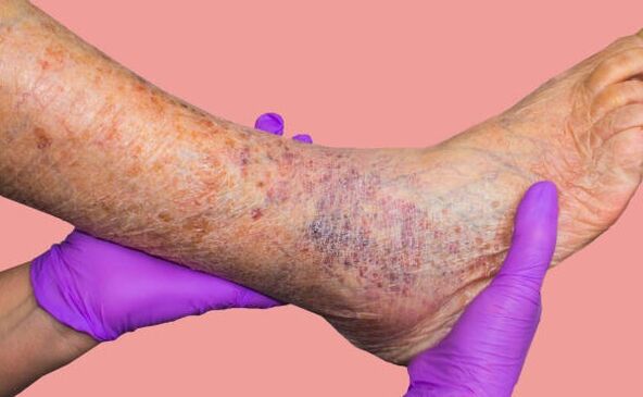 ¿Por qué son peligrosas las venas varicosas
