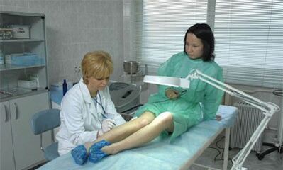 como tratar las venas varicosas en las piernas