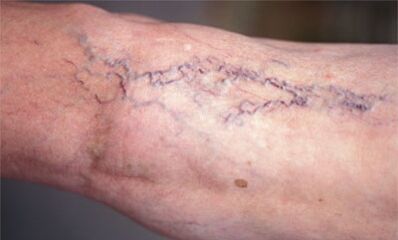 métodos para tratar las venas varicosas en las piernas