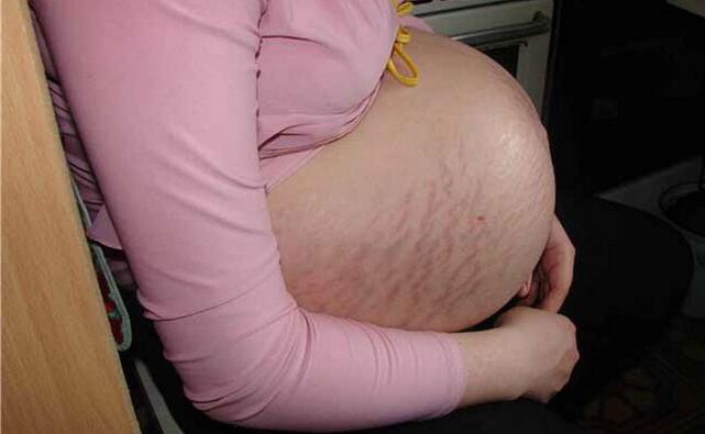 Causas de las venas varicosas durante el embarazo.