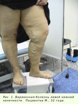 Las venas varicosas deben tratarse para detener el proceso.