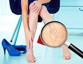 Los síntomas dependen de la naturaleza y el estadio de las venas varicosas.