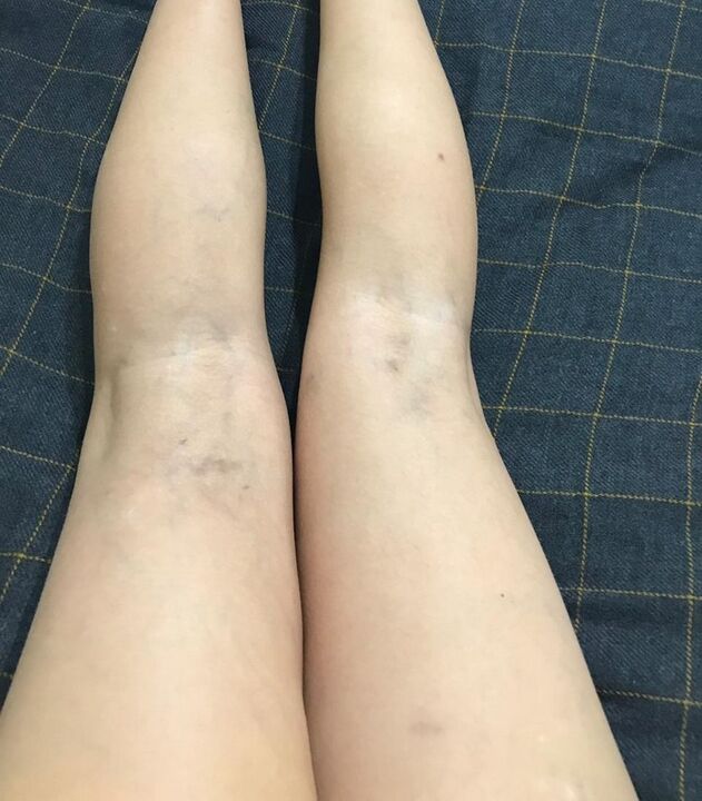 Manifestaciones de venas varicosas en las piernas.