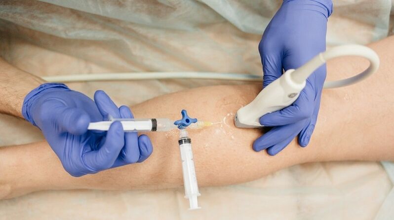 escleroterapia para venas varicosas