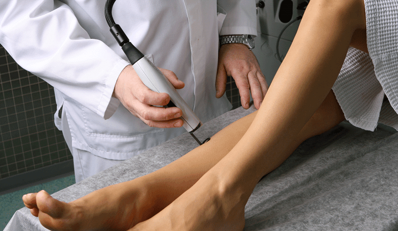 tratamiento con láser para venas varicosas