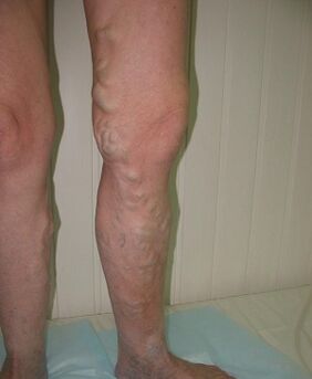 Venas abultadas en las piernas debido a venas varicosas.