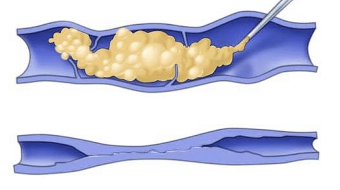 escleroterapia para venas varicosas