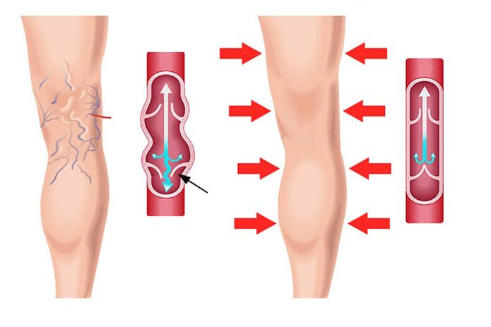 efecto del gel Levicose en el tratamiento